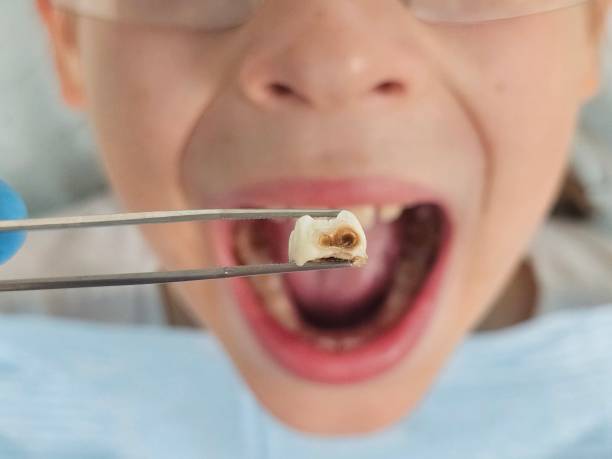 Best Emergency Dental Care for Broken or Chipped Teeth in East Stroudsburg, PA